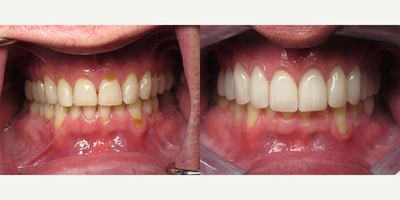 Porcelain Veneers before and after photo