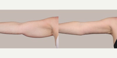 Arm Lift before and after photo