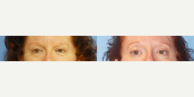 Eyelid Surgery before and after photo
