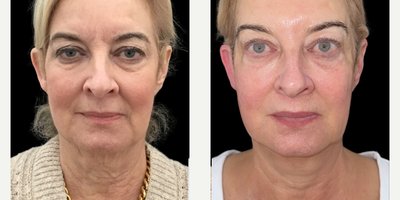 NeoGen Plasma before and after photo