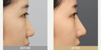 Rhinoplasty before and after photo