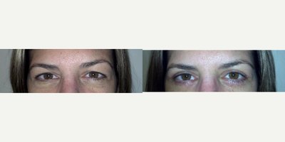 Eyelid Surgery before and after photo