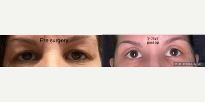 Eyelid Surgery before and after photo