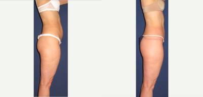 Body Lift before and after photo