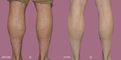 Calf Reduction before and after photo