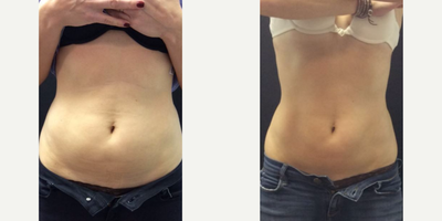 CoolSculpting before and after photo