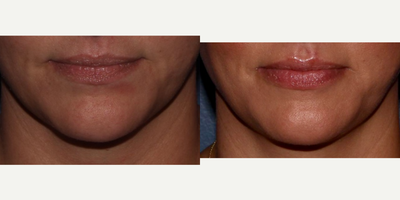 Dermal Fillers before and after photo