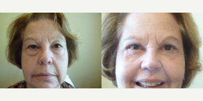 Eyelid Surgery before and after photo