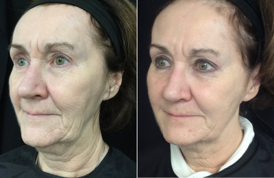 Ultherapy before and after photo