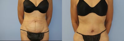 Tummy Tuck before and after photo