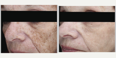 IPL before and after photo