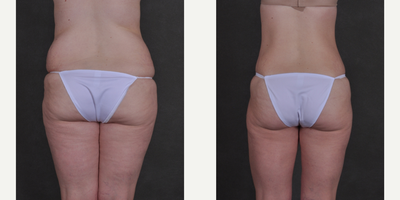 Liposuction before and after photo