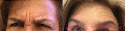 Botox before and after photo
