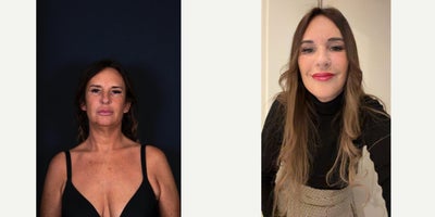 Facelift before and after photo
