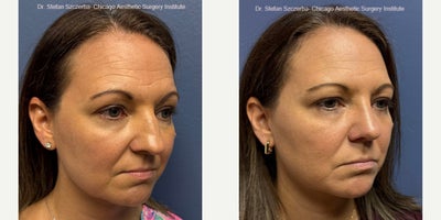 Rhinoplasty before and after photo