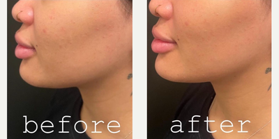 Chin Filler before and after photo