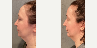 CO2 Laser before and after photo