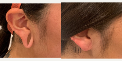 Earlobe Repair before and after photo