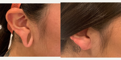 Earlobe Repair before and after photo