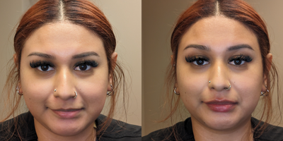 Juvederm before and after photo