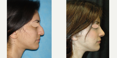 Rhinoplasty before and after photo