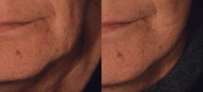 Skin Rejuvenation before and after photo