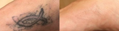 Tattoo Removal before and after photo