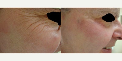 Dermal Fillers before and after photo