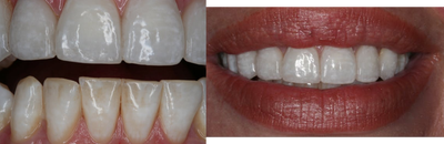 Smile Makeover before and after photo