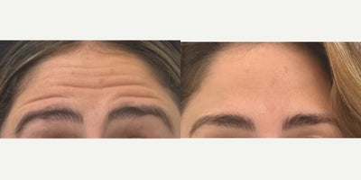 Botox before and after photo