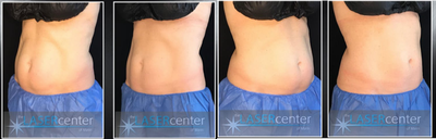 CoolSculpting before and after photo