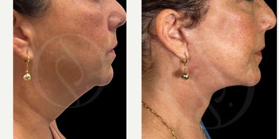 Deep Plane Facelift before and after photo