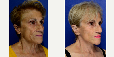 Facelift before and after photo