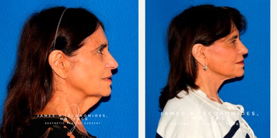 Facelift before and after photo