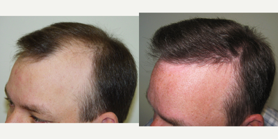 Hair Transplant before and after photo