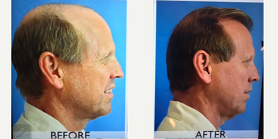 NeoGraft before and after photo