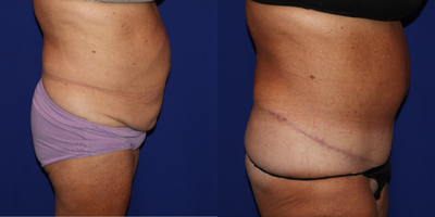 Tummy Tuck before and after photo