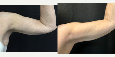 Arm Lift before and after photo