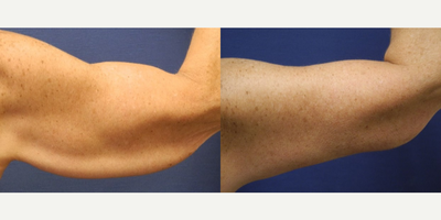 Arm Lift before and after photo