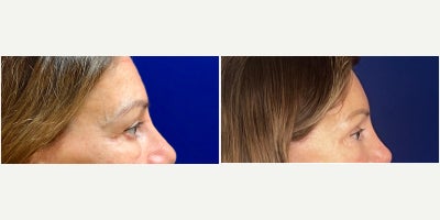 Brow Lift before and after photo