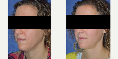 Liposuction before and after photo