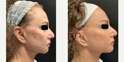Nonsurgical Facelift before and after photo
