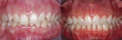 Smile Makeover before and after photo