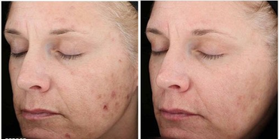Chemical Peel before and after photo