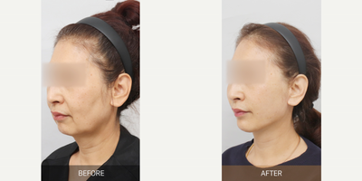 Chin Filler before and after photo