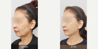 Chin Filler before and after photo