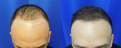 NeoGraft before and after photo