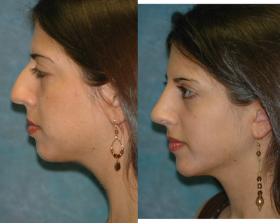 Rhinoplasty before and after photo
