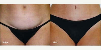 Tummy Tuck before and after photo
