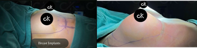 Breast Implants before and after photo
